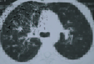 fungalasthma_ctscanbronchiectasis