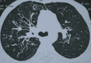 fungalasthma_ctscanbronchiectasis