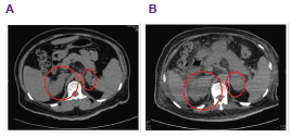 Abdominal CT scan showed increased bilateral adrenal mass