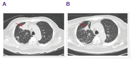 Lung CT scan showed RUL mass decreased after treatment
