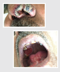 Clinical presentation of the patient with progressive nasal ulcer with crusting and painful palatal ulcer 