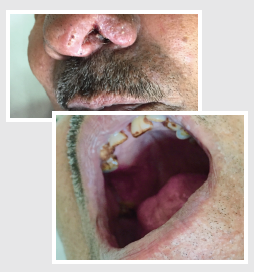 Marked regression in the nasal and palatal ulcers after 6 weeks on oral itraconazole therapy