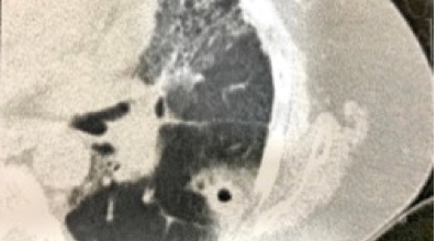 CT scan of the thorax showed thick-walled cavity with a surrounding halo sign in left lower lobe