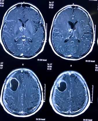 MRI with contrast showed a large abscess in the left frontoparietal region with multiple lesions located at the left basal ganglia region