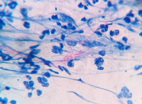 Direct microscopic examination of the brain abscess sample revealed partially acid-fast beaded filaments